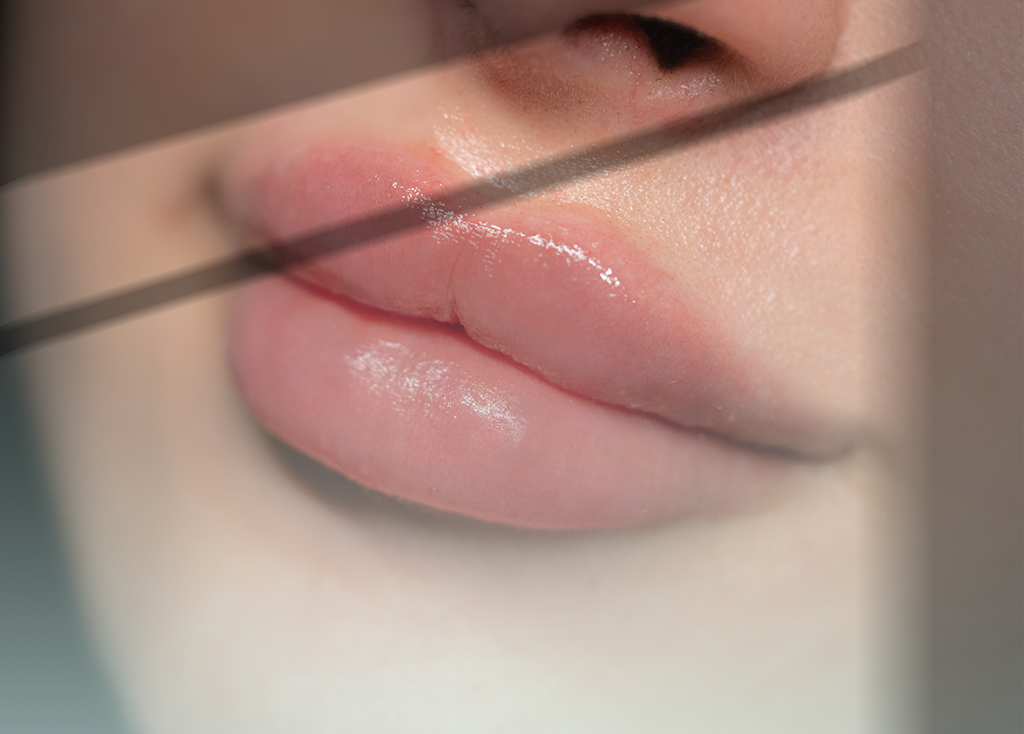 الحقــن التجمــيـــلي