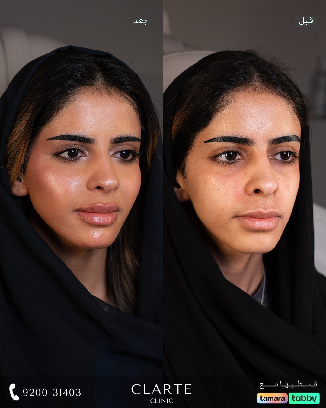 فيــلر وجه كامل