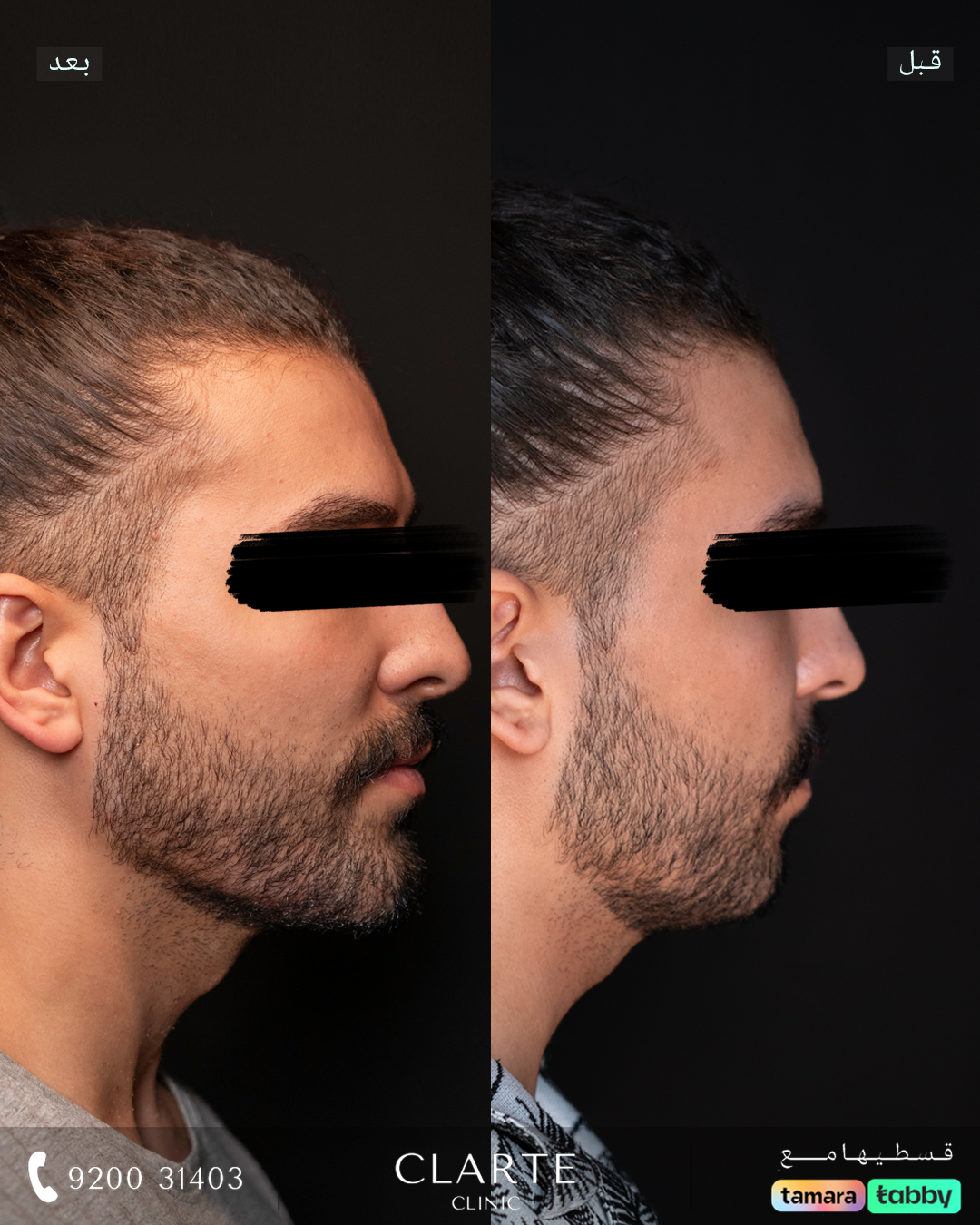 تحديد الفك " تكساس "