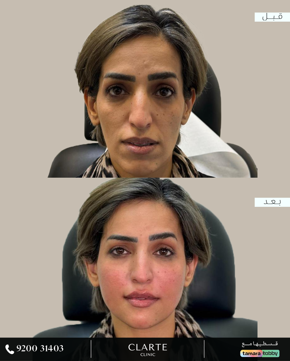 تقصـير الوجه بالفيــلر