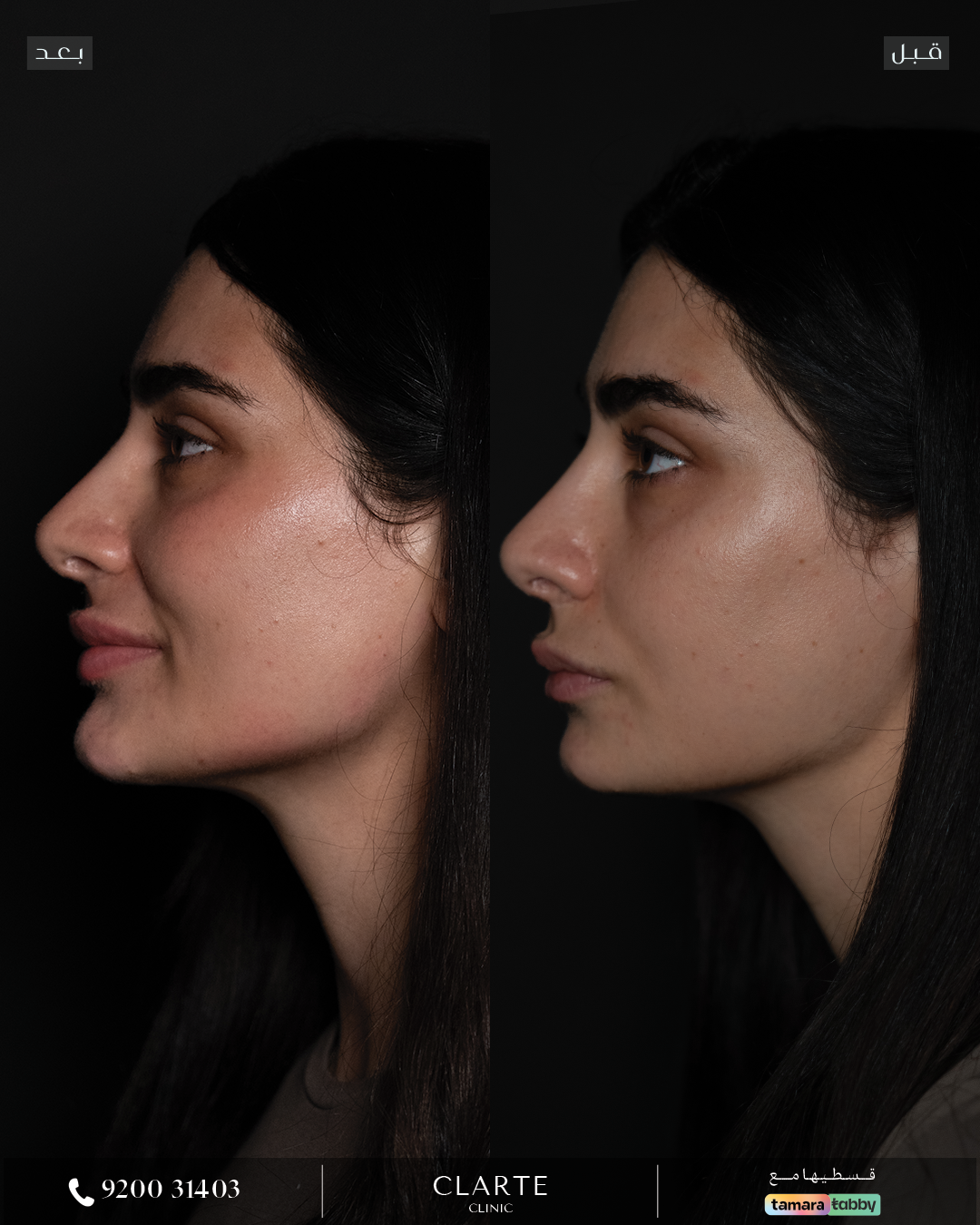 فيلر وجـه كامل