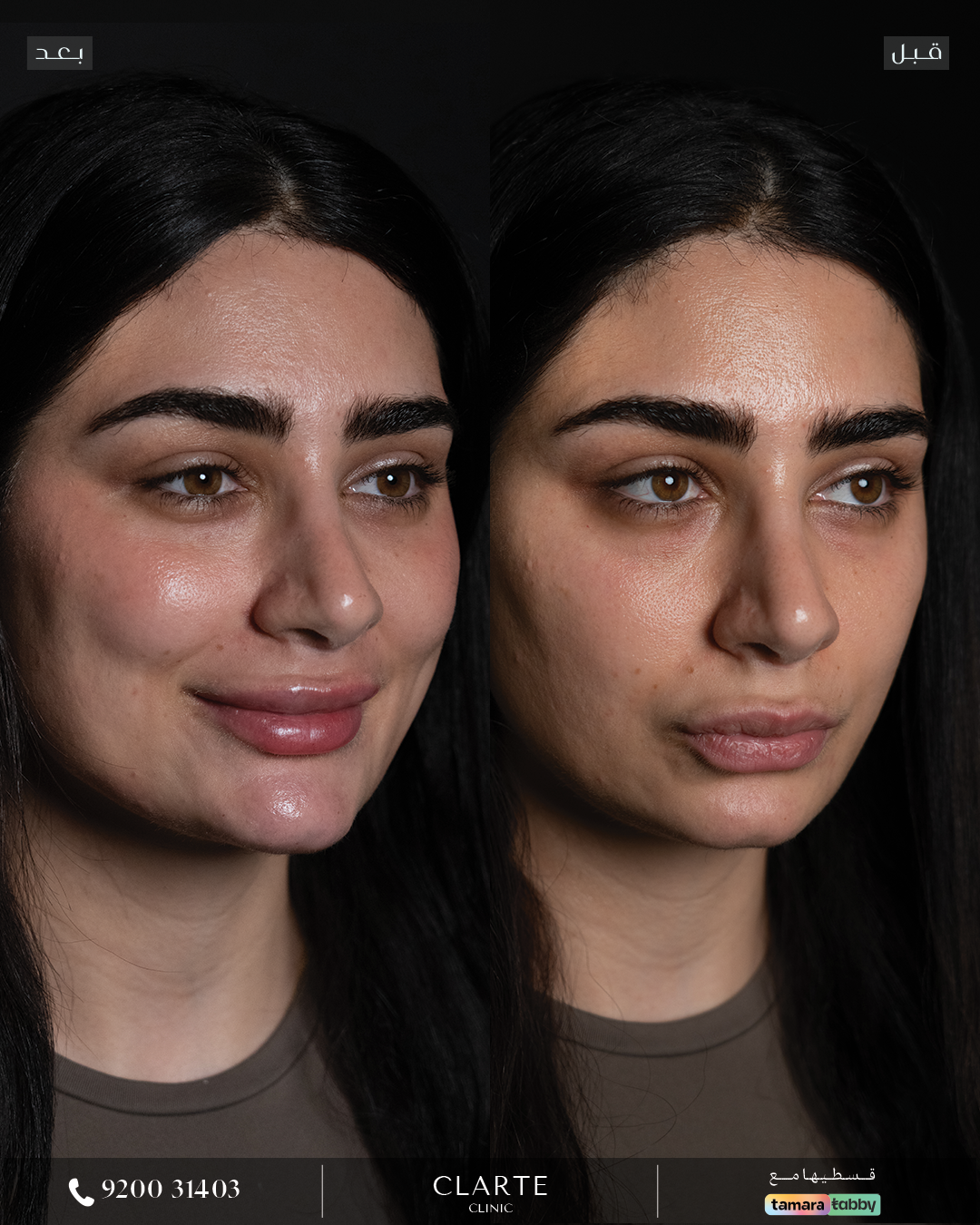 فيـلر وجه كامل