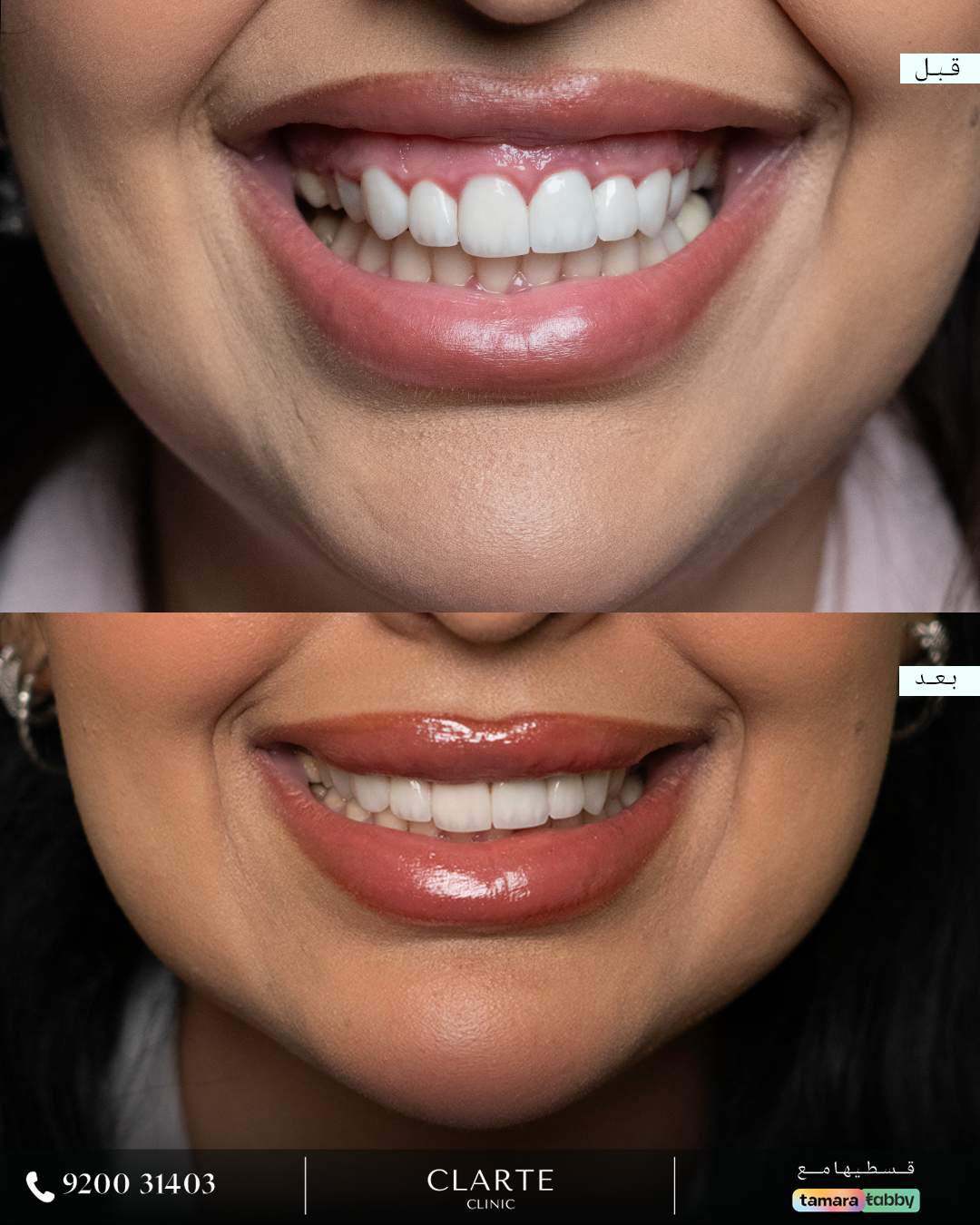 الابتسـامة اللثوية